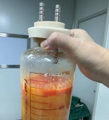 克孜勒苏水动力吸脂手术要做多久？